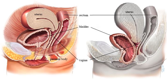 Normal anatomy compared with anterior vaginal wall prolapse (cystocele)