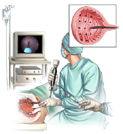 Botulinum toxin injection via cystoscope into bladder wall