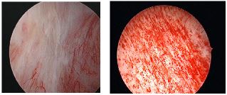 Interstitial cystitis: inflamed bladder lining with characteristic changes