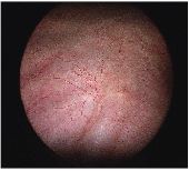 Normal bladder interior as seen during cystoscopy