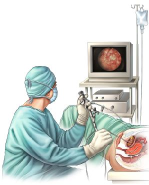 Cystoscopy procedure showing cystoscope insertion into the bladder