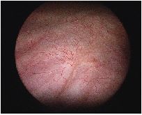 Normal bladder interior as seen during cystoscopy