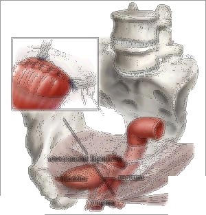 Uterosacral ligament suspension procedure showing apical sutures placed to the uterosacral ligaments