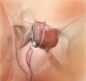 Retropubic sling — tape passes behind the pubic bone