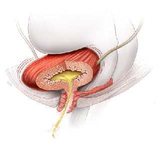 Overactive bladder — half full but contracting, causing urinary leakage