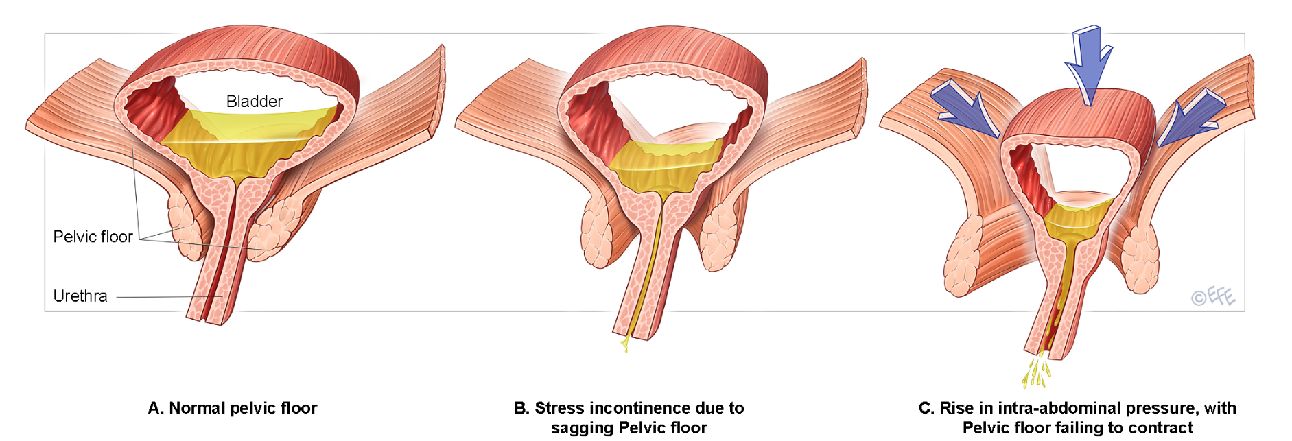 Weakened pelvic floor muscles showing how reduced support leads to urinary incontinence