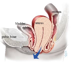 Apical compartment prolapse — the uterus or vaginal apex descends toward the vaginal opening