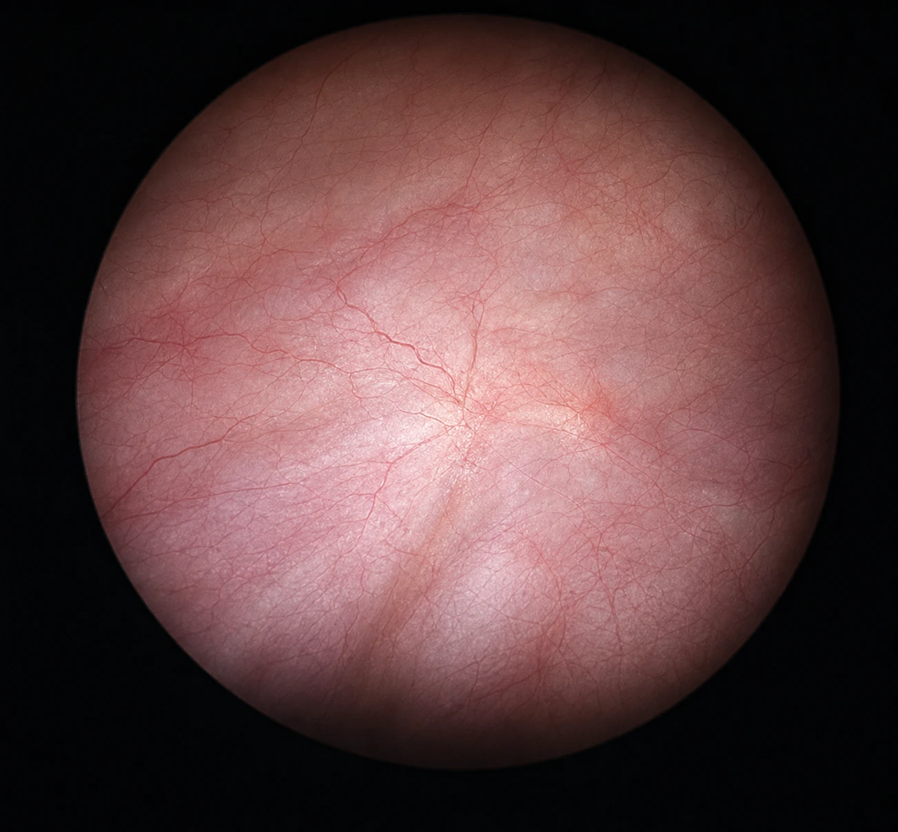 Illustrative view of smooth bladder lining through a cystoscope