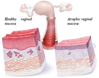 Vaginal, urethral, and bladder anatomy showing areas affected by estrogen