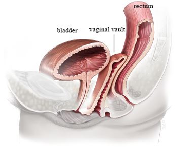 Anatomy after vaginal hysterectomy